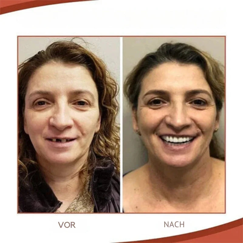 Snap on Veneers with Moldable Beads and Custom Fit False Teeth - Image 5